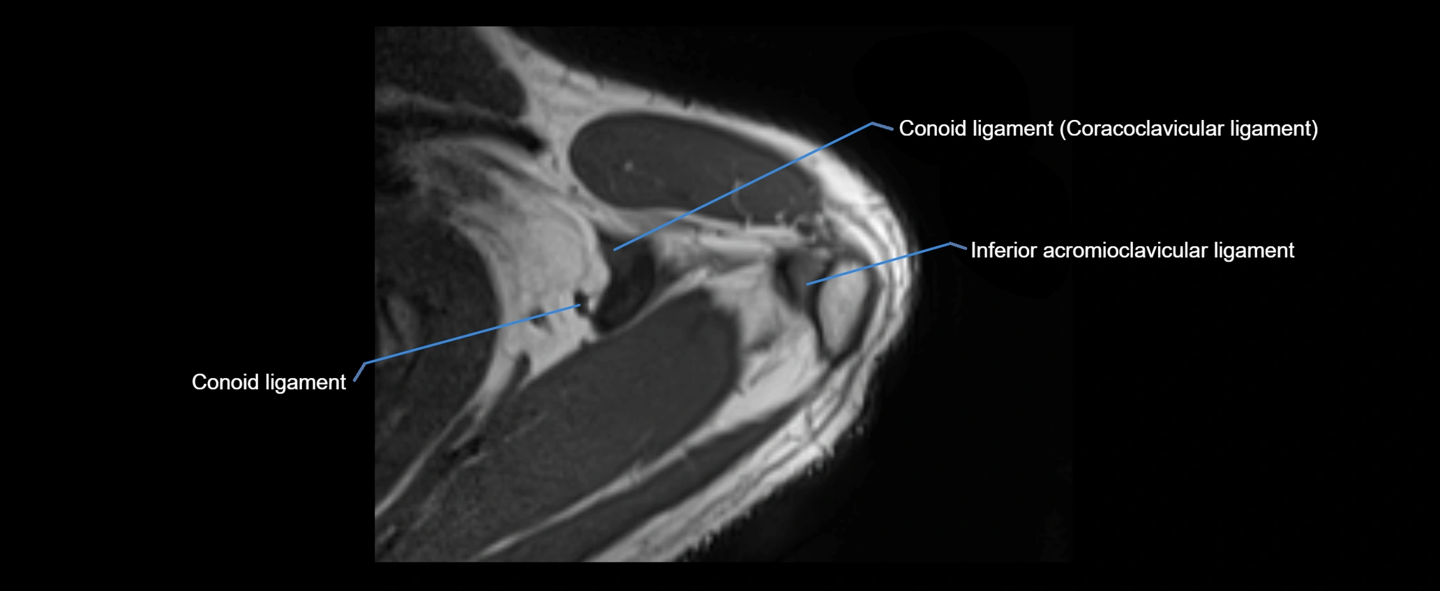 shoulder ligaments axial 3d 3t mri image-img-00005-00028.webp